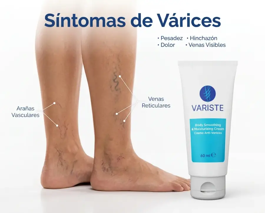 Síntomas de várices: pesadez, hinchazón, dolor, venas visibles y arañas vasculares